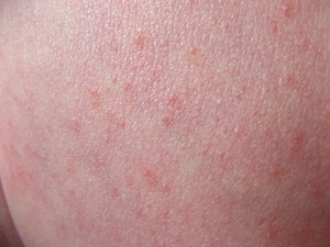 什么因素造成湿疹的出现?