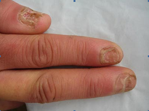 哪些人群容易患上灰指甲呢