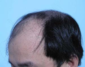 脂溢性脱发的病因有哪些?