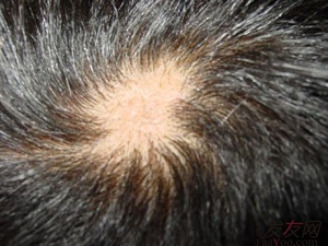 休止期脱发有哪些病因导致?