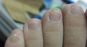 哪些外在因素导致灰指甲