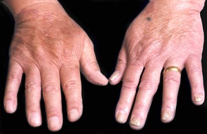 灰指甲有哪些详细症状