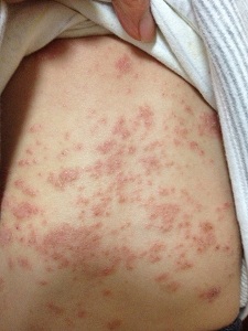 婴儿湿疹的症状有哪些