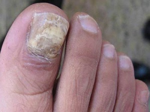 引起灰指甲的病因有哪些