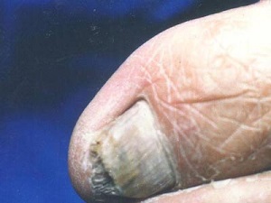 诱发灰指甲一般有哪些症状