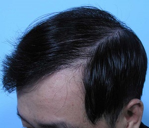 脱发有哪些致病因素