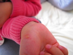 皮炎和湿疹具体有哪些区别